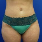 liposuction